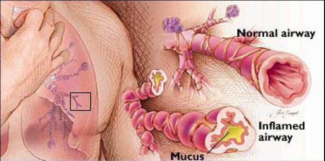בהתקף אסטמה הסימפונות מתכווצות ומתמלאות ליחה, והאויר אינו יכול לעבור דרכן - ונוצרת הרגשת חנק